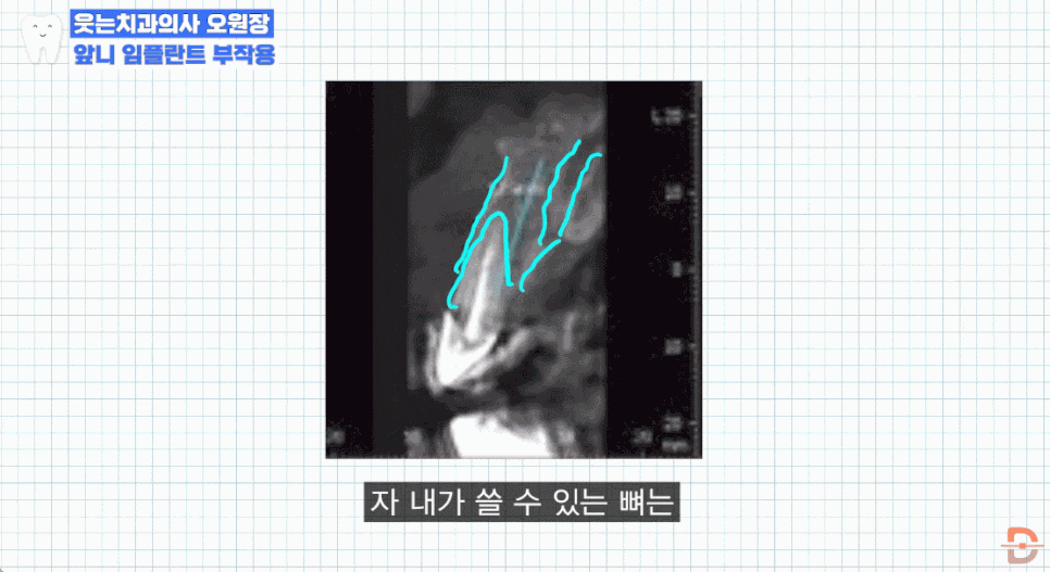 앞니임플란트치과 찾기 전 제발 이 글부터 읽어보세요 관련 이미지 19