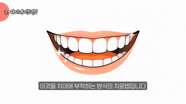 라미네이트와 크라운의 차이, 어떤 기준으로 선택할까요? 관련 이미지 3