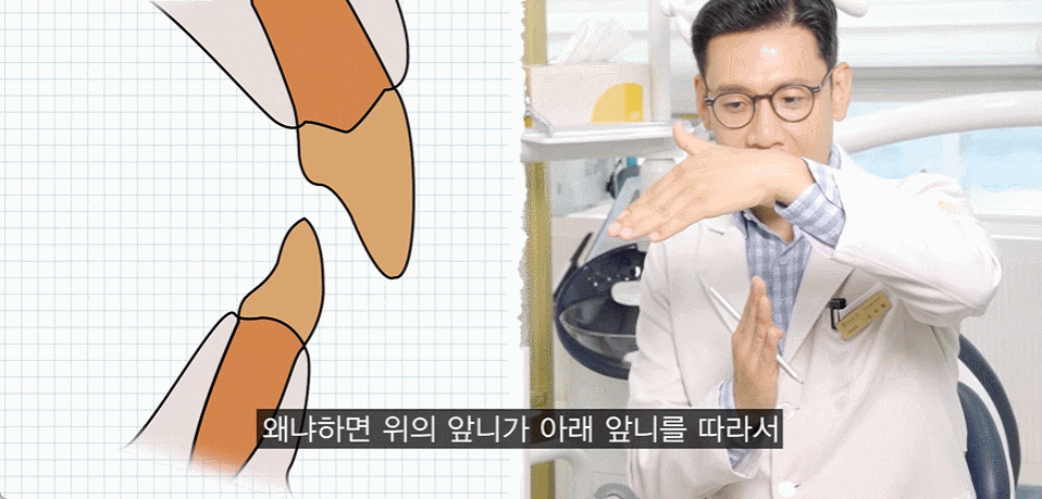 무턱교정전후, 얼굴 라인 어떻게 달라지는지 <공개> 관련 이미지 4