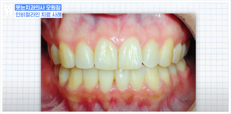 치아 인비절라인 아무도 안 알려주는 솔직한 장단점 (투명교정치과) 관련 이미지 2