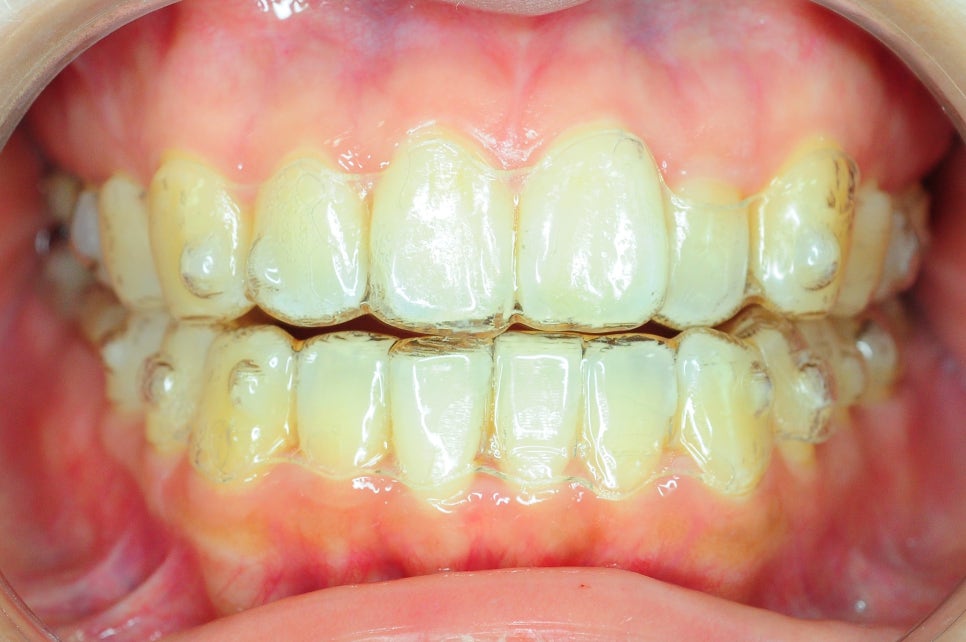 Does Invisalign Really Not Hurt? Do You Have to Have Teeth Extracted? image 8