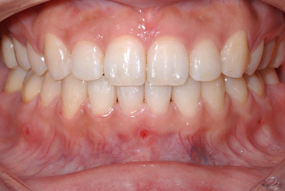 What Is the Key to Correcting Deep Bite and Inward-Tipped Teeth? Must Read to Avoid Retreatment image 7