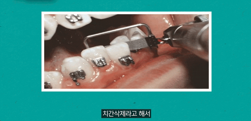 Can Extractions That Affect the Length of Correction for Crowded Canines Be Avoided? image 6