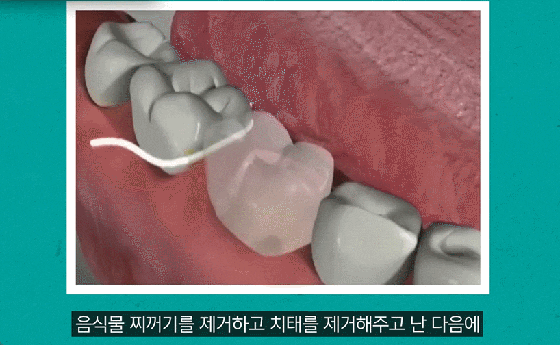 Flossing Order: Before Brushing? After? The Correct Way to Use Dental Floss image 4