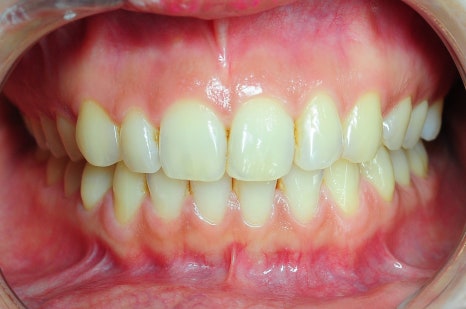 치아미백비용 아까워 셀프 미백했다가 후회하는 이유 관련 이미지 1