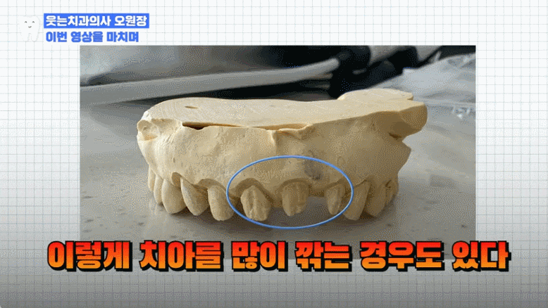 덧니라미네이트, 절대 그냥 하면 안 되는 이유 관련 이미지 8