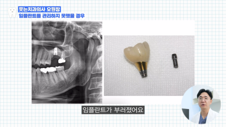 If You Want Your 40s Dental Implant to Last 10 or 20 Years, Check This First image 9