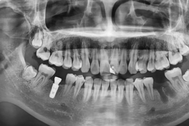 If You Want Your 40s Dental Implant to Last 10 or 20 Years, Check This First image 10