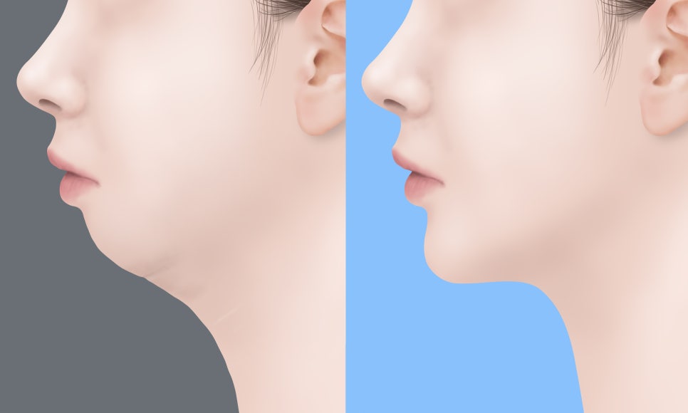 무턱교정 전후 사진만 찾아보고 있다면 반드시 확인해야 할 것들 관련 이미지 3