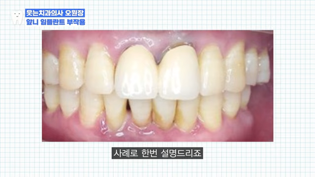임플란트 OO하게 심으면 가짜 이빨 다 티납니다 관련 이미지 2