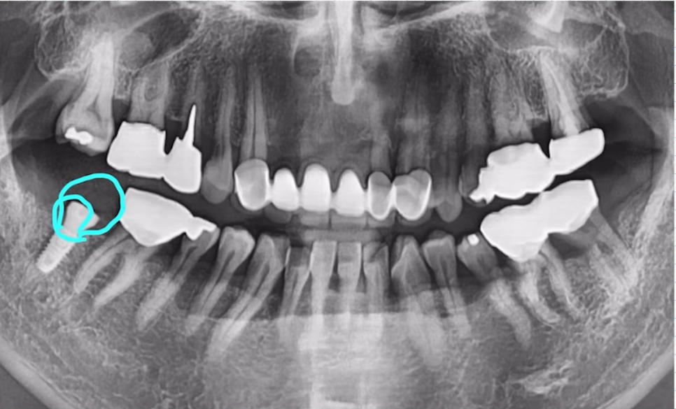 임플란트수술, 당일임플란트로 빠르게 끝내고 싶으신가요? 관련 이미지 6