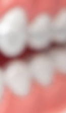 성인 돌출입 교정, 발치 없이도 변화가 가능할까? 관련 이미지 39