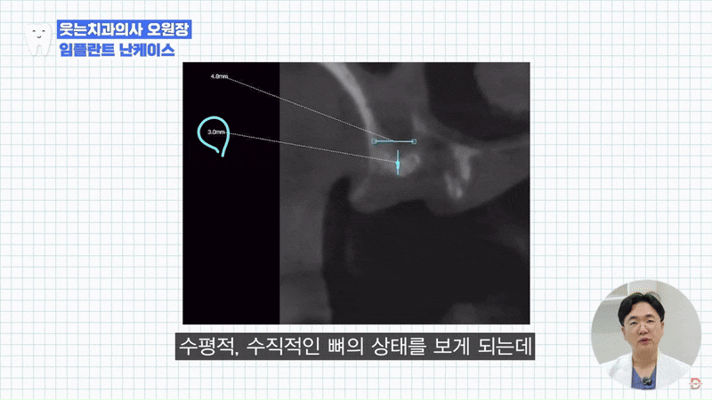 Looking Into Full Implant Placement Methods and Precautions image 11