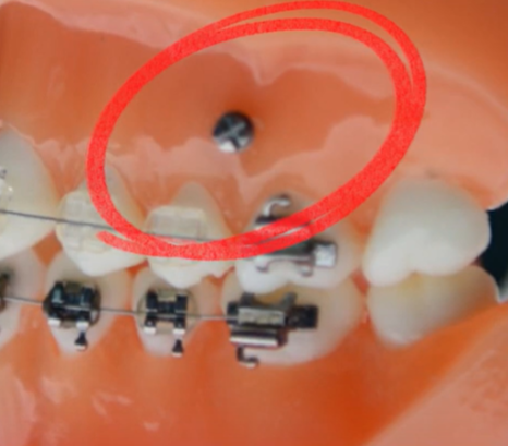 Seoul Orthodontic Clinic: Invisalign drawbacks? Why do they even place Invisalign screws? image 10