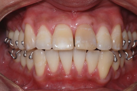 교정후앞니벌어짐, 2년간의 노력이 물거품? 관련 이미지 5