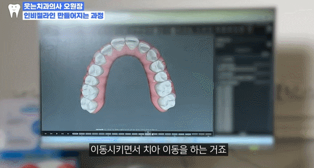 티안나는교정, 웃을 때 교정기 싫으시다면? 관련 이미지 12