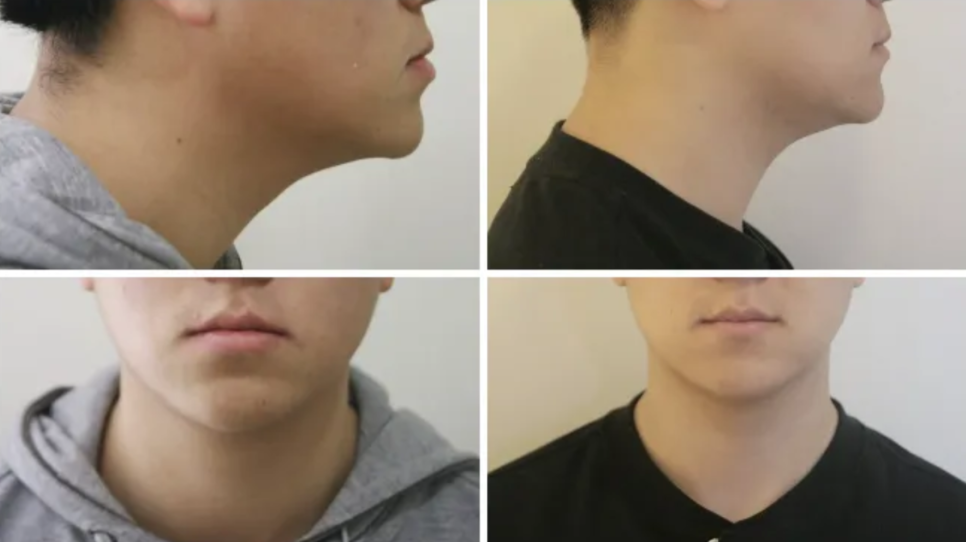 Protruding Mouth Correction and Underbite Correction: A Case Improved Without Surgery image 11