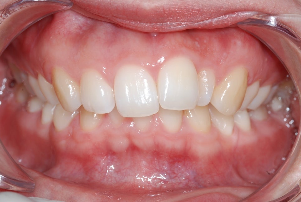 Key Points on the Principles, Duration, and Pain of Orthodontic Rubber Bands, as well as Clear Aligner Costs image 2