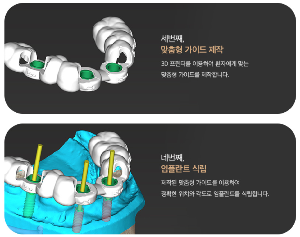 If You Want Your 40s Dental Implant to Last 10 or 20 Years, Check This First image 12