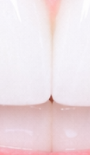 What to Check Before Choosing a Gangnam Laminate Dental Clinic image 40