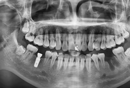 Is Same-Day Implant Possible? What You Must Know Before Implant Surgery image 4