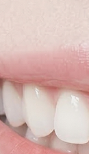 서울라미네이트치과 알아보고 있다면 관련 이미지 28