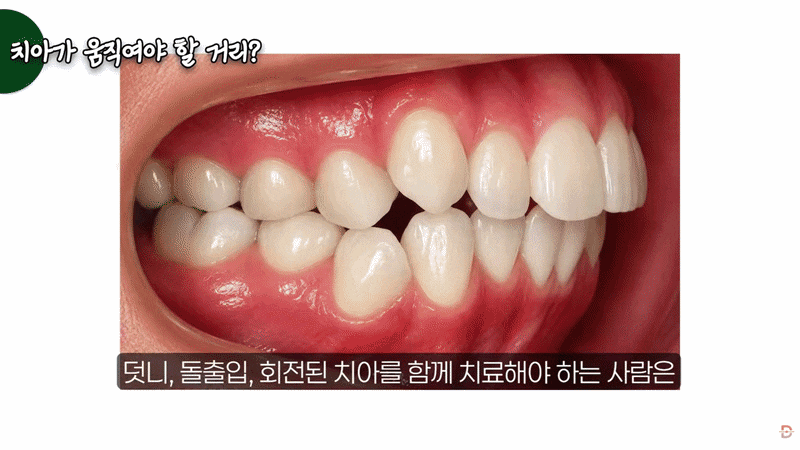 강남치아교정, 가지런함보다 먼저 확인해야 할 6가지 기준들은? 관련 이미지 4