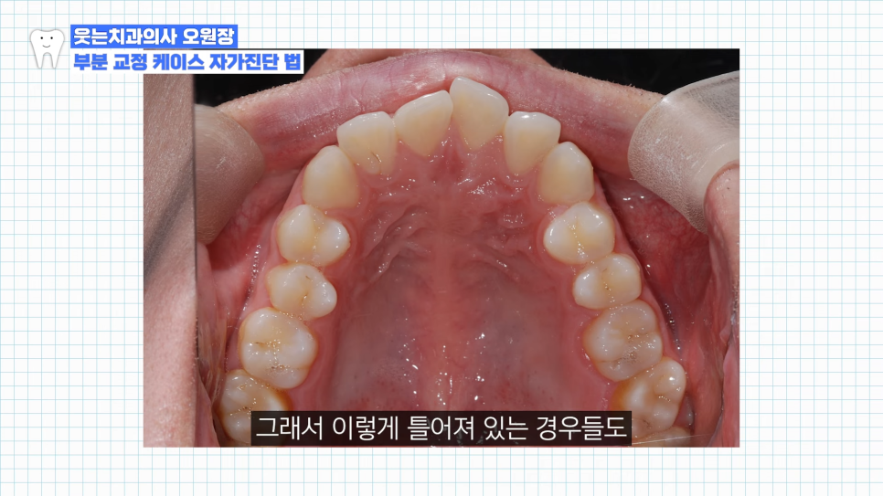 부분교정하고 이렇게 변했습니다 교정 전후 비교 관련 이미지 6