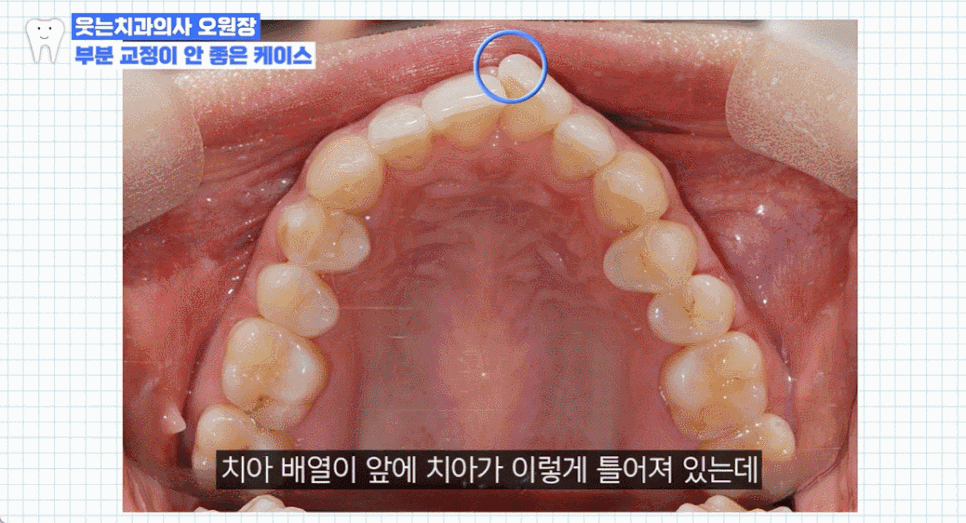 나비 앞니 교정 관련 이미지 3