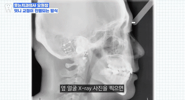 강남교정치과 다니고 관련 이미지 7