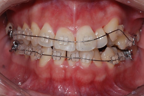 덧니 라미네이트와 덧니 교정, 뭐가 더 나을까요? < 18년차 전문의 답변> 관련 이미지 7