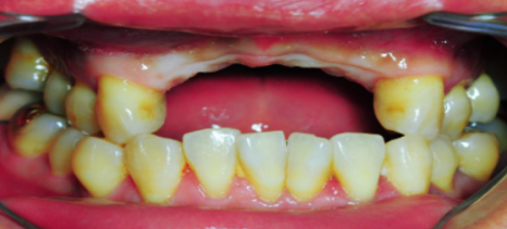 임플란트 뼈이식 비용 들이기 전 이 글부터 읽어보세요 관련 이미지 1