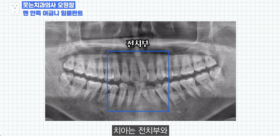 강남임플란트잘하는곳, 내 치아 같은 편안함은 어떻게 만들어질까? 관련 이미지 2