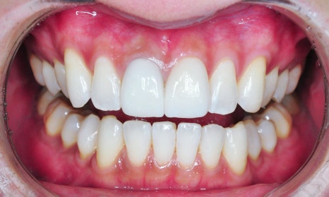 크라운 치료 가격 신경치료 후 크라운 꼭 해야 할까요? 관련 이미지 2