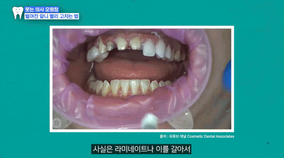 Gap Between the Front Teeth? Don’t Judge It by Front Teeth Partial Orthodontic Reviews Alone image 14