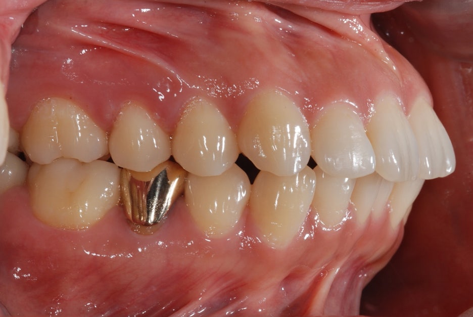 Gap Between the Front Teeth? Don’t Judge It by Front Teeth Partial Orthodontic Reviews Alone image 5