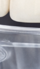 40대 치아 교정 고민 중이라면? 부담 줄이고 효율 높이는 선택법 관련 이미지 30