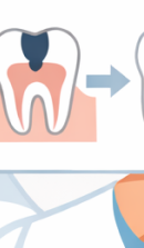압구정 라미네이트치과 자연스러운 완성을 위한 선택 기준? 관련 이미지 40