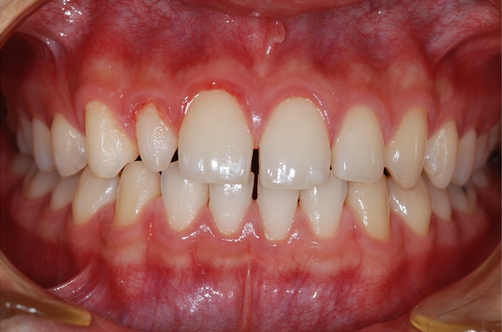 Gapped Front Teeth: Resin? Orthodontics? If You’re Unsure, Consider This image 1