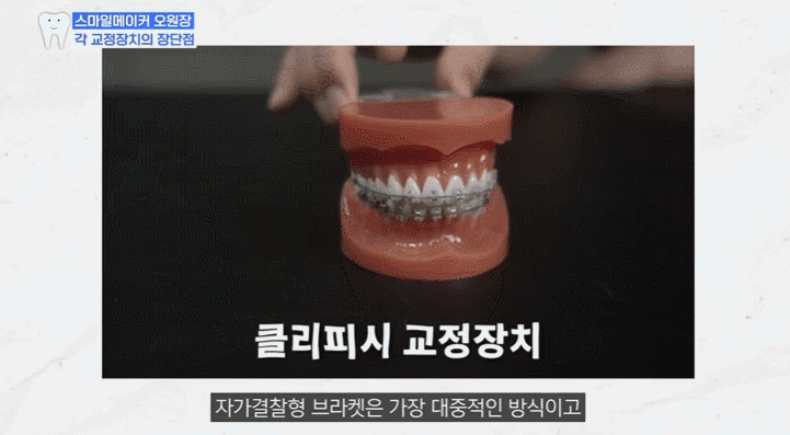 세라믹교정 vs 클리피씨교정, 뭐가 다르고 뭘 골라야 할까? 관련 이미지 5