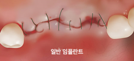 Can Non-Incisional Implants Reduce the Implant Treatment Period? <Doctor's Answer> image 10