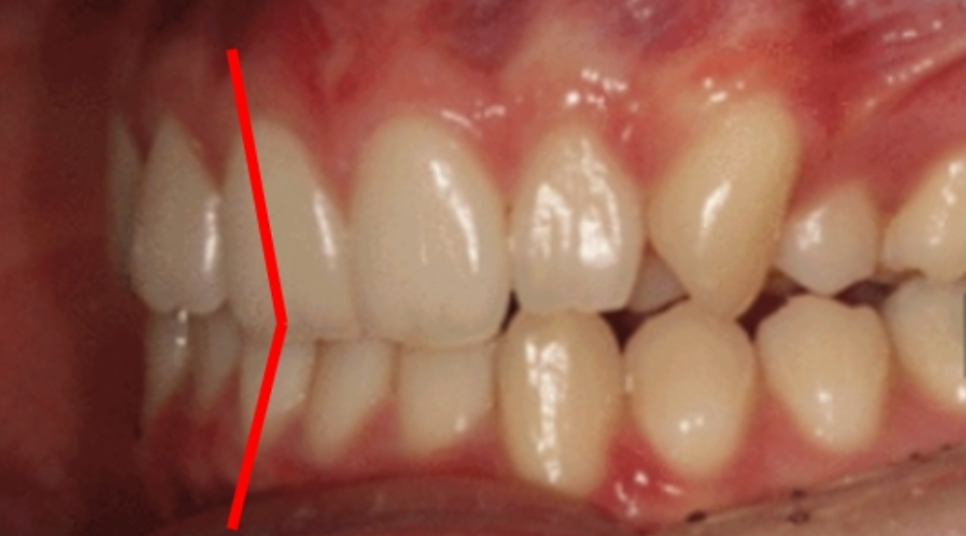 Can You Smile Again After Orthodontics Caused a Protruded Upper Lip? image 1