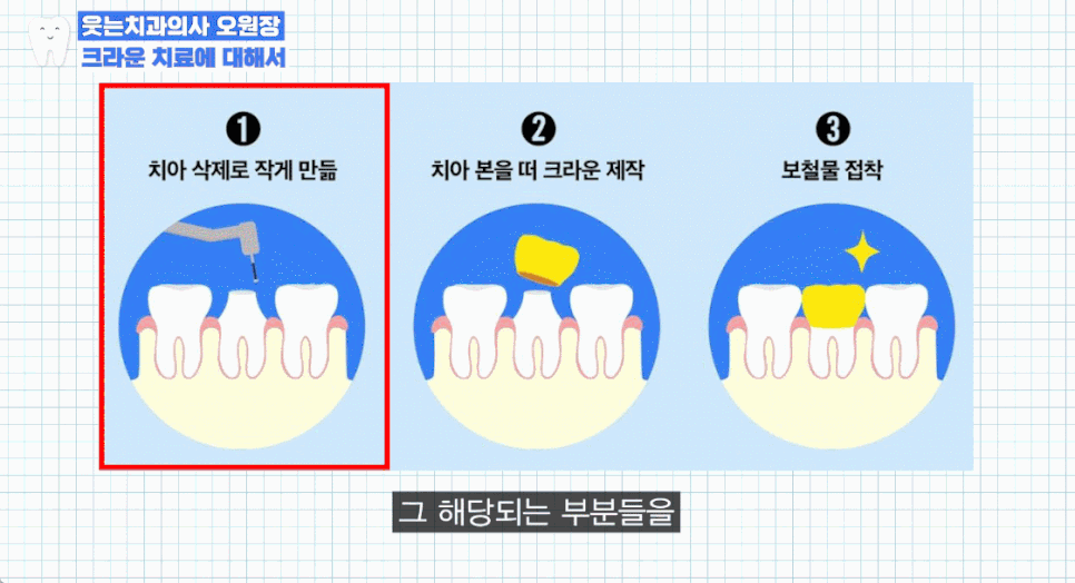 크라운 치료 가격 신경치료 후 크라운 꼭 해야 할까요? 관련 이미지 16