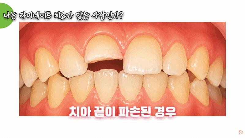 신사역 라미네이트, 자연스러운 인상을 위해 확인할 것들은? 관련 이미지 17