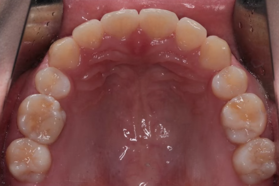 돌출입수술 대신, 인비절라인 돌출입 개선 사례 관련 이미지 13