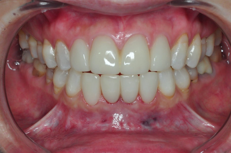 If You Want to Avoid Side Effects from Gangnam Laminate Veneers, Check These 2 Things image 3