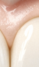 40대 치아 교정 고민 중이라면? 부담 줄이고 효율 높이는 선택법 관련 이미지 25