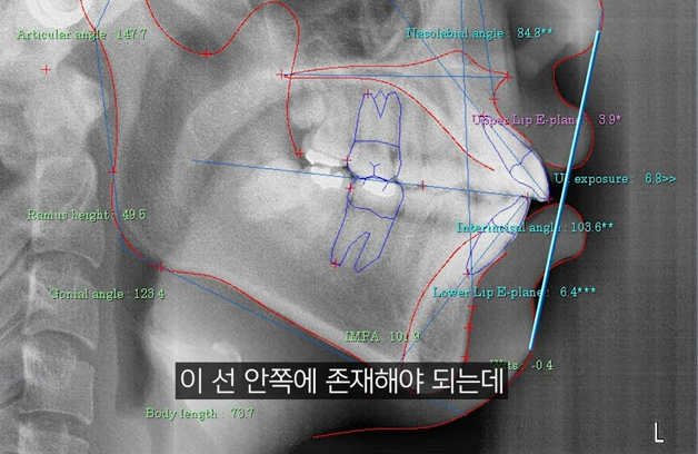 Before and After Protruding Mouth Correction: Principles, Advantages, and Disadvantages of Clear Aligners and Lingual Orthodontics for Protruding Mouth image 2