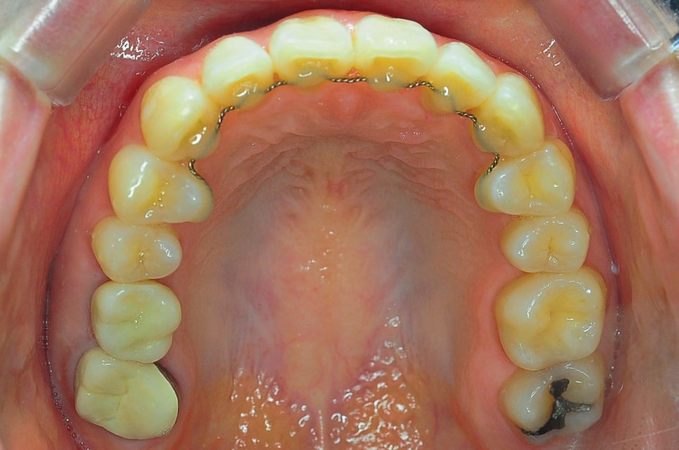 Does Invisalign Really Not Hurt? Do You Have to Have Teeth Extracted? image 11