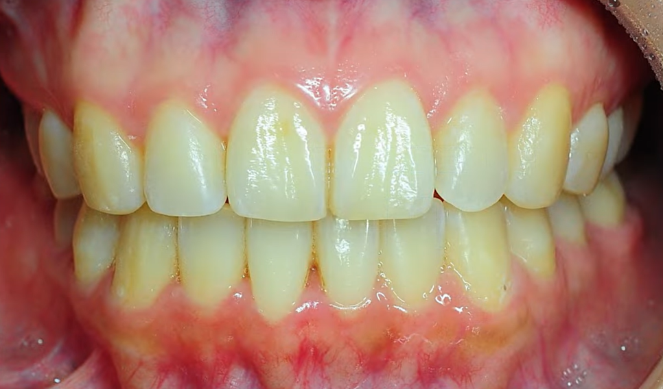 Invisalign Cases: Here’s How Much Can Change Without Brackets image 17